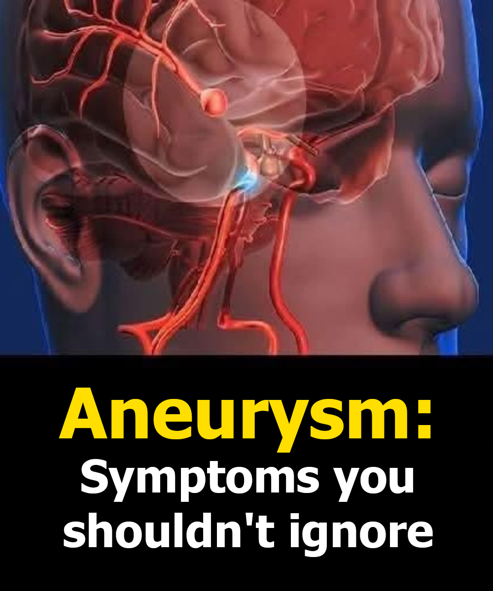 Aneurysm: Signs You Shouldn't Ignore...
